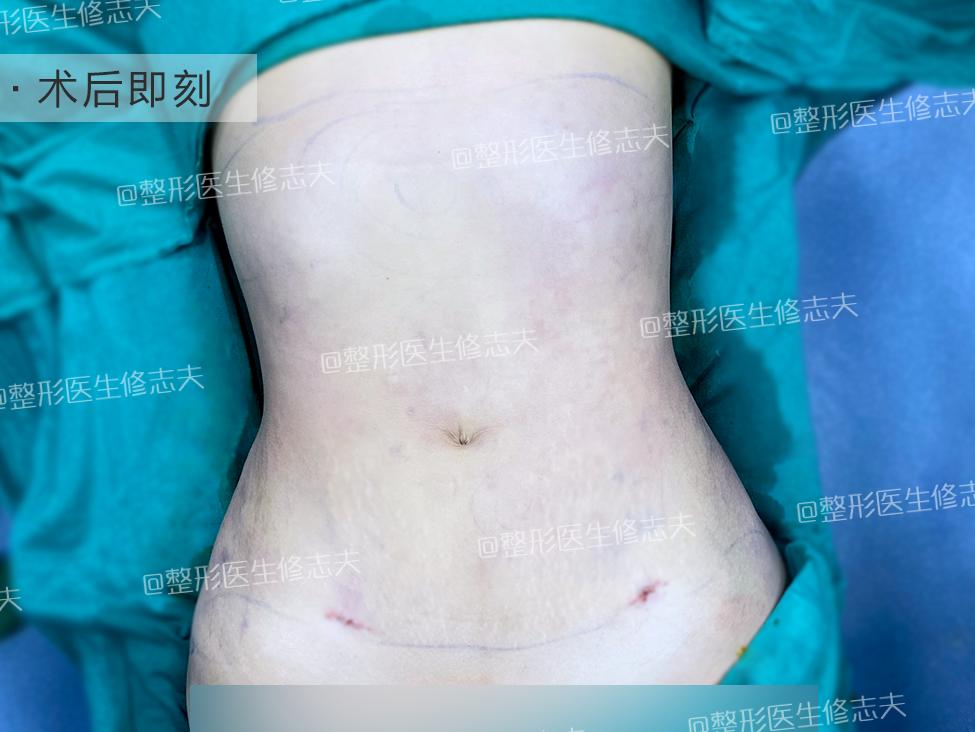 最新吸脂技术助你轻松塑造理想身材!