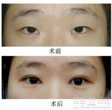 双眼皮手术费用全解析，割双眼皮手术价格与双眼皮手术费用详解